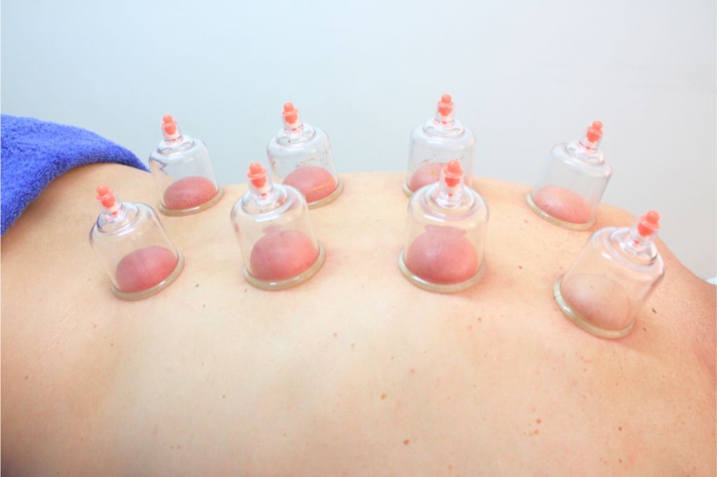 Myotherapy services - Cupping - Surf and Sport Myotherapy (1024px)