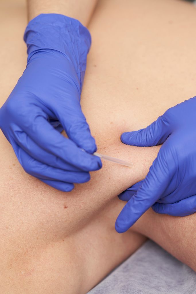 Dry Needling services Frequently asked questions - Surf and Sports Myotherapy
