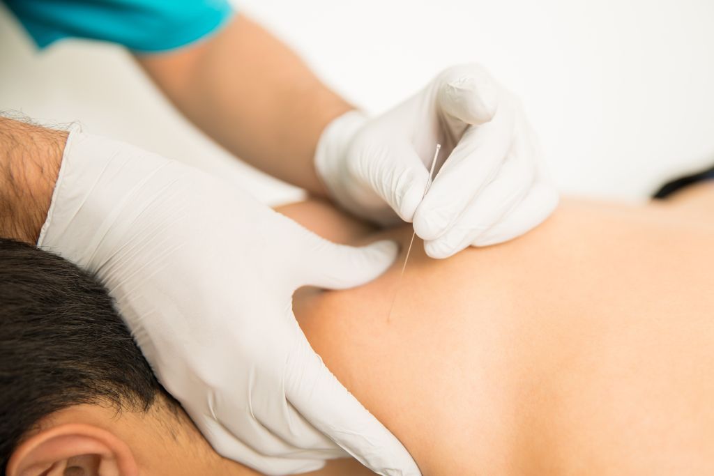 Dry Needling services Locations - Surf and Sports Myotherapy